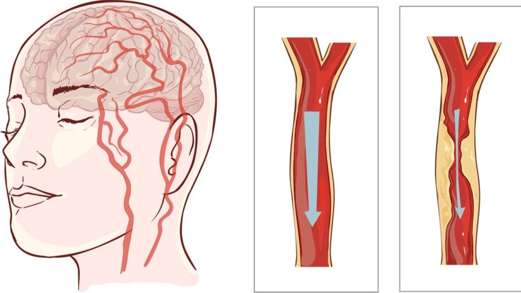 голова и артерии
