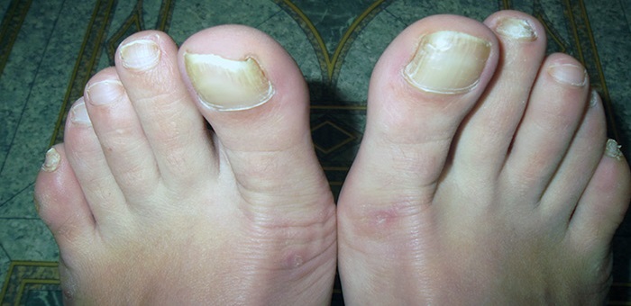 Жёлтые ногти на ногах какие причины и лечение,Post navigation