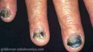 Грибок ногтей с вторичной инфекцией