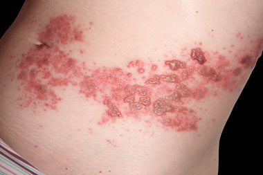 Опоясывающий лишай - это инфекционная болезнь, поражающая кожные покровы