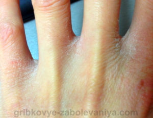 Трещины и шелушения между пальцами рук фото