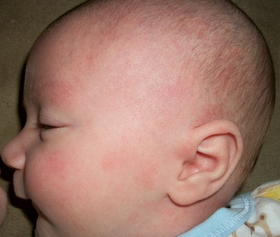 Виды и причины сыпи на лице у новорожденного,Post navigation