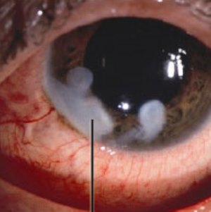 Ожоги глаз от электрической сварки: степени и терапия