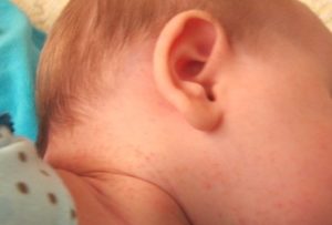Потница на шее у ребенка почему появляется и как лечить,Post navigation