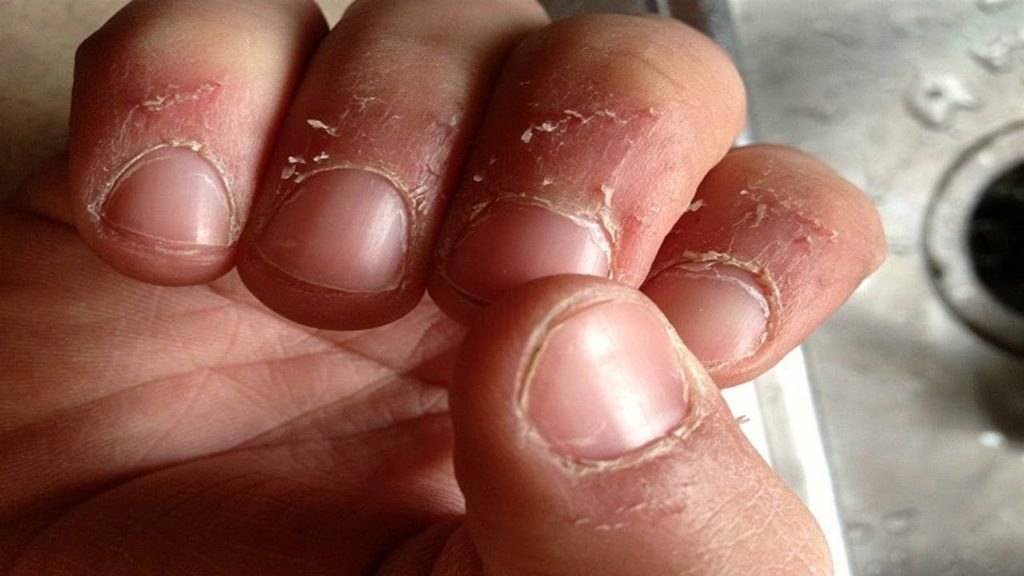 Трещины рядом с ногтями возникают по разным причинам