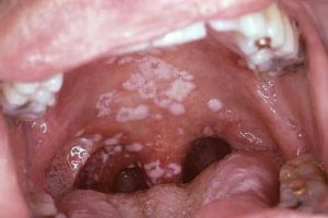 Белый налет в горле появляется из-за инфекций