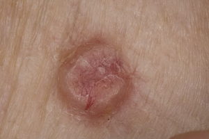 Плоскоклеточный рак кожи,Post navigation
