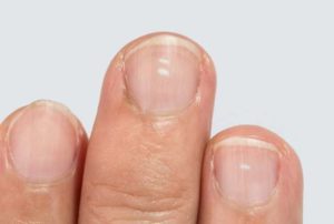 Белые пятна на ногтях рук что это означает?,Post navigation