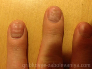 Волнистые ногти на руке