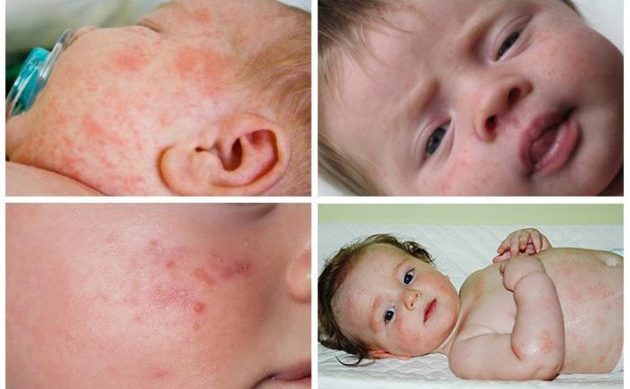 Реакция пищевых аллергенов на организм ребенка
