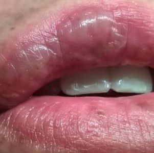 Симптомы и лечение ожога на губе