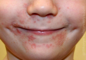 Периоральный дерматит - покраснение вокруг рта у ребенка фото