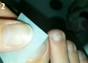 Специальной наждачкой зачищаем поверхность пораженного грибком ногтя.