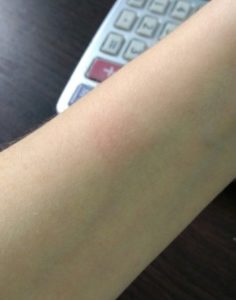 Аллергия на руке 