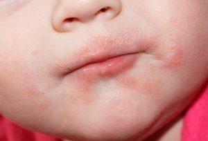 Сыпь может свидетельствовать об атопическом дерматите
