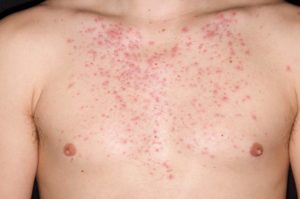 Красные точки могут свидетельствовать об аллергической реакции