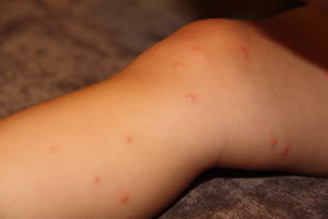 Сыпь на ногах в виде красных точек что за болезнь может быть,Post navigation