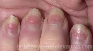 Волнистые ногти у женщины 33 лет