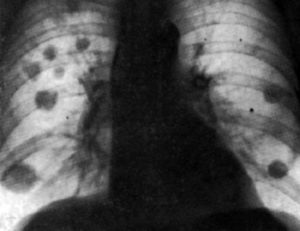 диссеминированный туберкулез снимок
