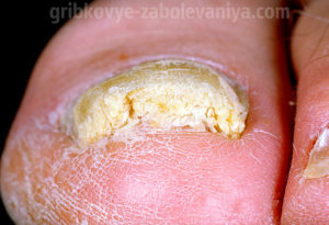 Онихомикоз - грибок ногтей фото