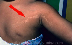 Линейный лишай или лихеноидный дерматит на плече