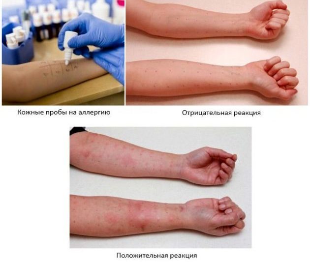 Аллергия или гиперчувствительность