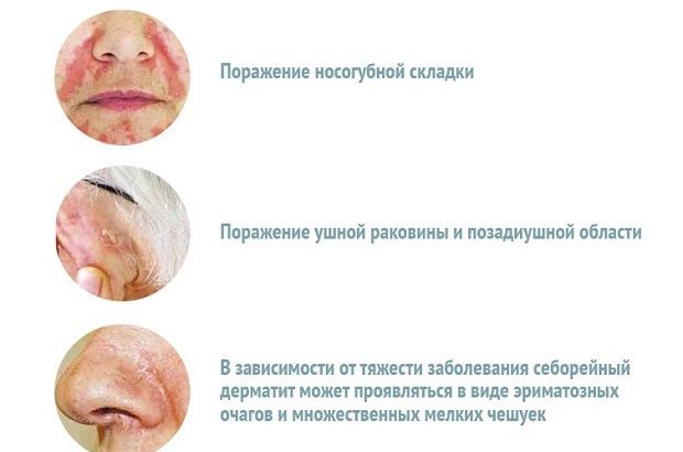 Себорейный дерматит лица