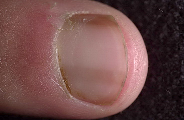 Коричневые пятна на ногтях рук или ног,Post navigation