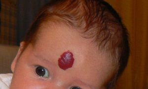 Почему появилось красное пятно на лбу у новорожденного?,Post navigation
