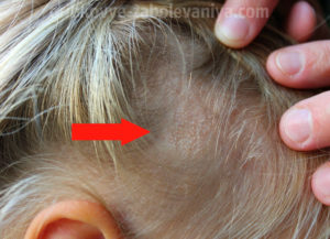 Трихофития - стригущий лишай на голове девочки 4 года