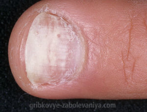 Онихомикоз - грибок на ногтях