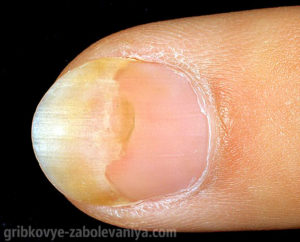 Онихолизис - грибок на ногтях