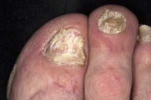 Псориазом ногтей страдает 3% населения