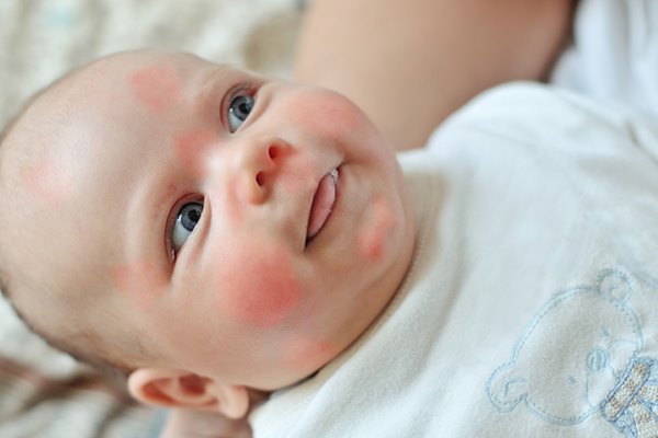 Сыпь на лице у новорожденного,Post navigation