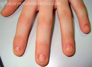 Ониходистрофия ногтей у детей