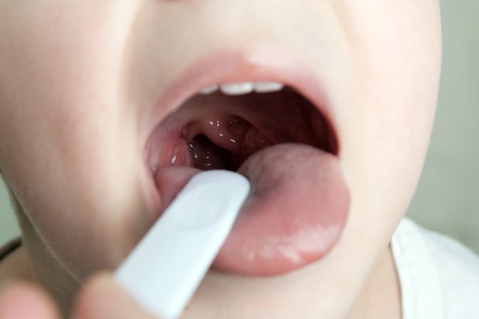 Сыпь на языке у ребенка все причины и лечение,Post navigation