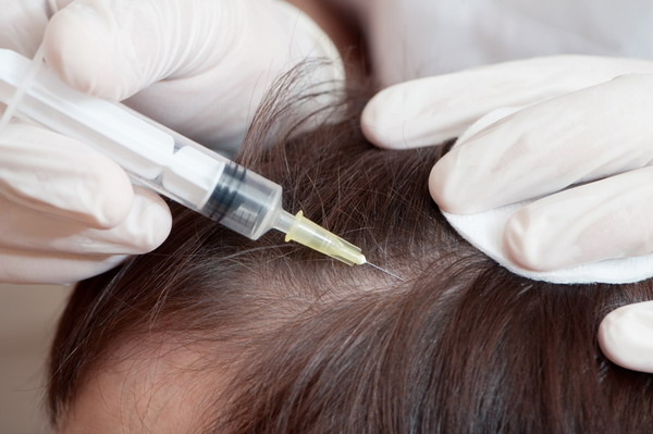 лечение волос алопеция