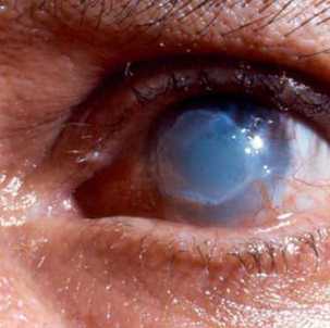 Первая помощь и лечение химического ожога глаза