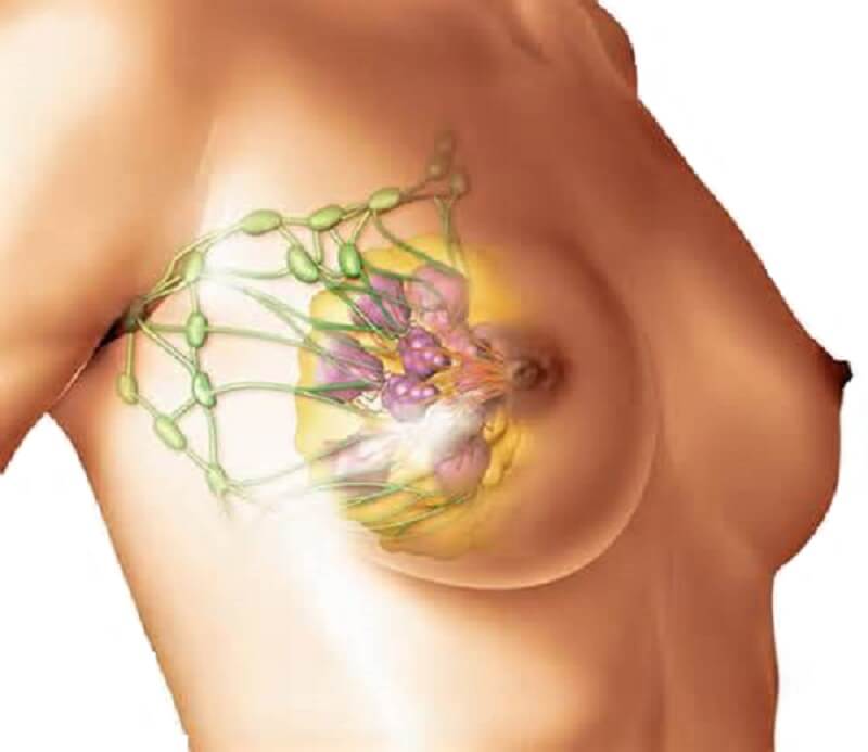 причины развития фиброзной мастопатии молочных желез