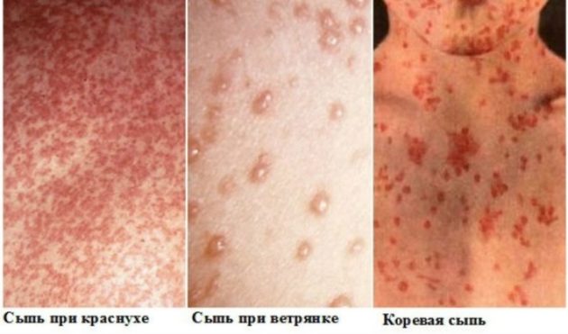 Инфекционные заболевания кожи