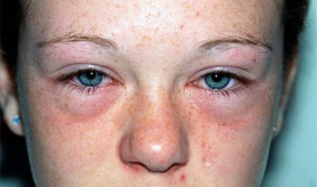 Аллергический отек глаз