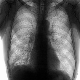 Причины возникновения инфильтративного туберкулеза легких
