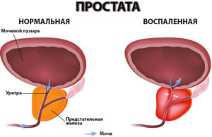Простатит - нормальная и воспаленная простата