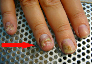 Онихомадезис ногтей