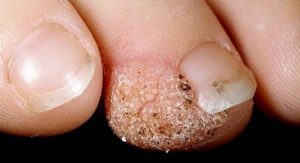 Грибок - одна из причин наростов под ногтями