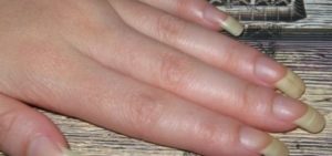 Почему загибаются ногти на руках?,Post navigation