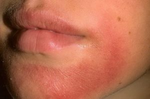 Причины покраснение и шелушение кожи на лице,Post navigation