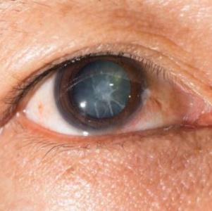 Ожоговая травма роговицы глаза: причины, симптомы и лечение