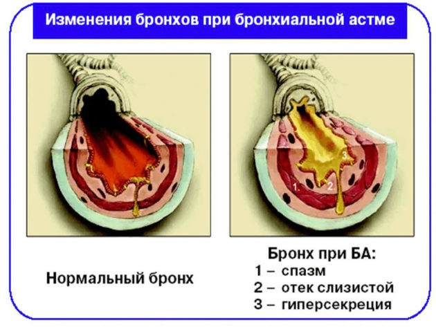 Изменения бронхов при бронхиальной астме