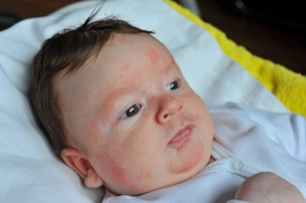 Аллергия у малыша
